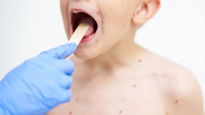 ABD'de salgın alarmı! Vaka sayısı 223'e yükseldi