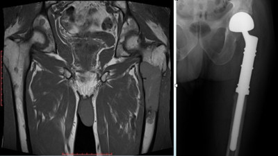 Kemik ve organ sağlığını tehdit eden hastalığa karşı çığır açan tedaviler