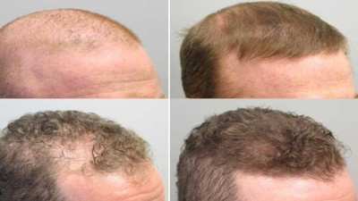 Saç ekiminin psikolojik etkisi: Boşanan bile var...