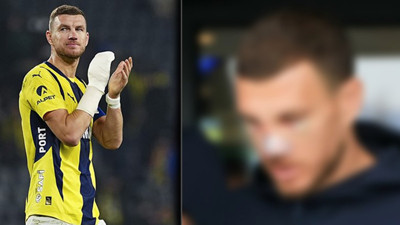 Burnu kırılan Edin Dzeko'nun son hali