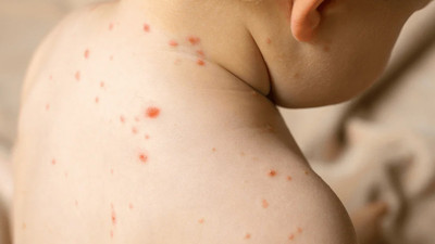 Kızamık vakaları hızla artıyor! 1 can daha aldı