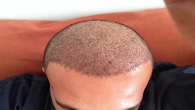 Saç ekimi sonrası başarı rehberi! Bu kurallara dikkat