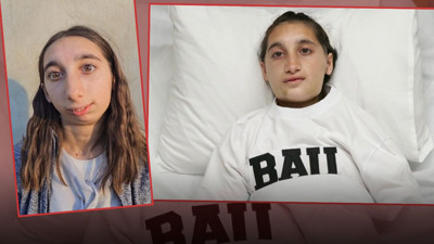 Sosyal medyada gündem olmuştu: 3 yaşında geçirdiği kaza hayatını altüst etti!