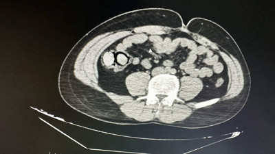 Midelerinden zehir çıktı