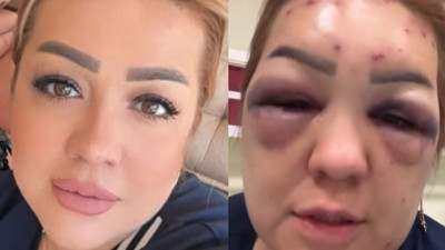 Kuaförde yaptırdığı botoks bir anda hayatını kararttı! Yüzü tanınmaz hale geldi