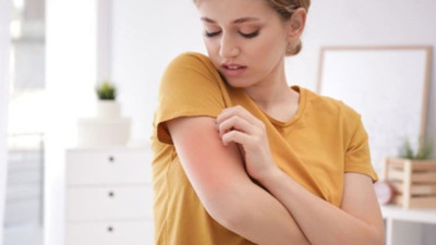 Kurdeşeni yatıştıran iksir! Sofranızdaki üç kahraman