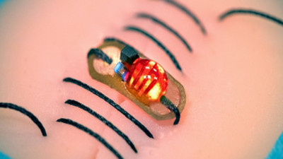 Akıllı dikiş devrimi! Enfeksiyonlara karşı erken uyarı