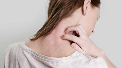 Egzama, sedef ve mantara doğal çözüm! Ciltte devrim yapacak bitki