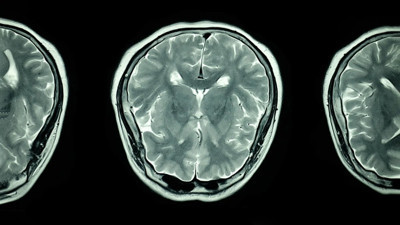 Felçten kurtuluşun anahtarı yapay zeka destekli dil köprüsünde mi? Uzmanlar anlatıyor