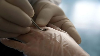 Yazın kabusu geri döndü! Kene ısırmasına karşı doğru bilinen yanlışlar! Uzmanlar uyarı üstüne uyarı yaptı