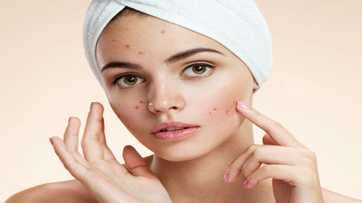 Sivilceyi bitiren üç ot! Sivilceye karşı bitkisel devrim