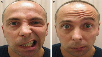 Botoks yüz felci yapar mı? Uzmanlar bilimsel verilerle açıkladı