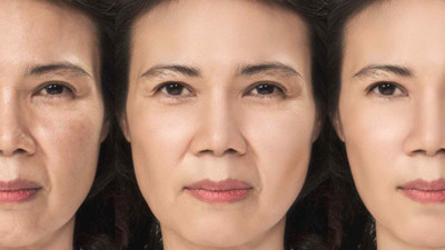 Yüz germe ameliyatlarında gizli tuzaklar ortaya çıktı!