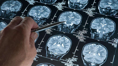 Alzheimer’a erken müdahalede umut! Bilimsel devrim