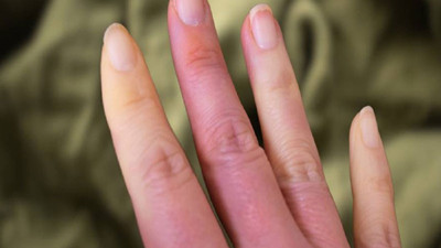 Parmaklardaki belirti ortaya çıktı! Gizli katil ölüm nedeni