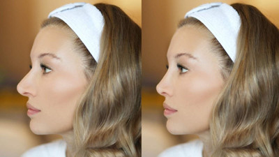 Yaz sıcağında burun ameliyatı riskleri! Uzmanlardan kritik uyarılar