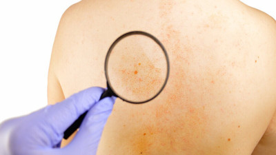 Cildinizdeki gizli tehlike! İki belirti hayatınızı değiştirebilir