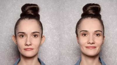 Kepçe kulakta özgüveni artıracak sırrı uzmanlar anlattı