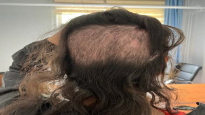 Otel odasında saç ekimi kabus oluyor! Uzmanlar uyarılarını sıraladı