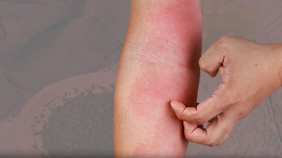 Cilt hastalıklarını tuş ediyor! Kansere duvar örüyor! Bu otun mucize faydalarını bilim doğruladı