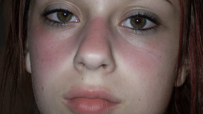 Lupus hastalığı nedir? Lupus ölümcül mü?