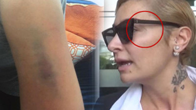 Ekimoz nedir? Ekimoz nasıl oluşur?