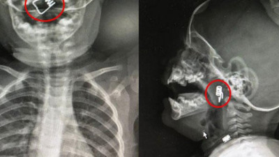 1 yaşındaki bebeğin boğazında tespit edildi