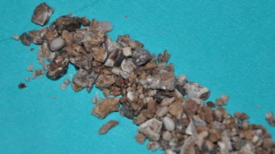 Böbreklerinden 'geyik boynuzu' şeklinde 500'den fazla taş çıktı