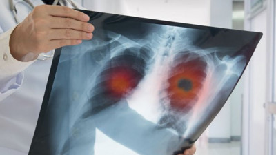 KOAH hastalarına 'rahat nefes' için 8 öneri