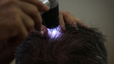 Kellik sorununa yerli ilaç çözümü