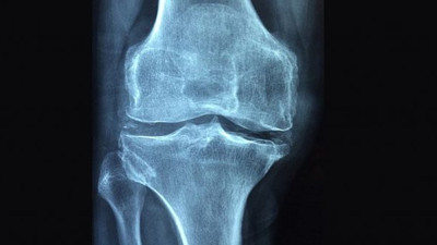 'Osteoporoz 3 kadından birini kıskacına alıyor'