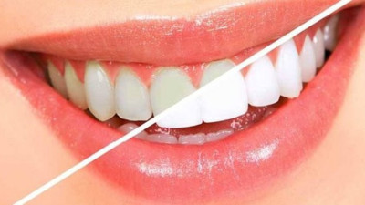 Diş sağlığınız için bu besinlerden uzak durun!