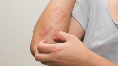 İşte egzamayı önlemenin 10 yolu