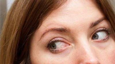 Gözlerdeki kanlanma göz tümörünün belirtisi olabilir!