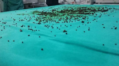 Safra kesesinden 3 bin 765 taş çıkarıldı