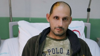 3 boyutlu yazıcı ile yapılan kafatası hastaya uygulandı