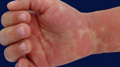 Ebeveynlerde 'kawasaki' hastalığı paniği