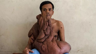 Bu adamı gören gözlerine inanamıyor: 40 kilo tümör ile dolaşıyor