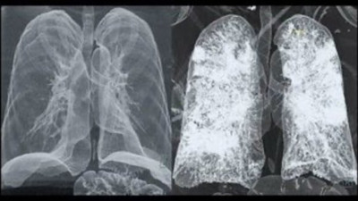 Korona ciğerleri bu hale getiriyor: Siz hâlâ dışarıda gezin