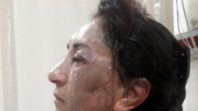 Boşanma aşamasındaki eşinin yüzüne kezzap attı