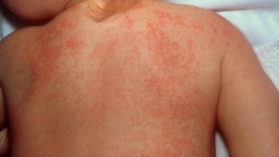 Fransa'da ilk kez bir çocuk öldü! Yeni kâbus Kawasaki!