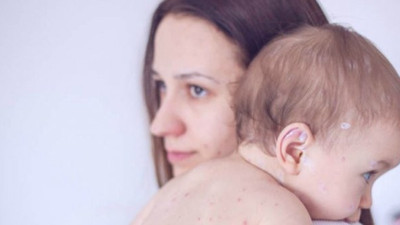 Kızamık hakkında yeni araştırma