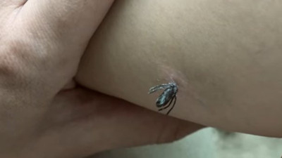 İşte keneden korunmanın en etkili yolu