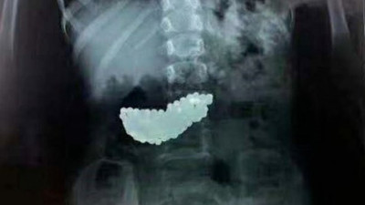 Anne-babalar dikkat! Sizin de başınıza gelebilir! 5 yaşındaki kızın mide filmi şok etti