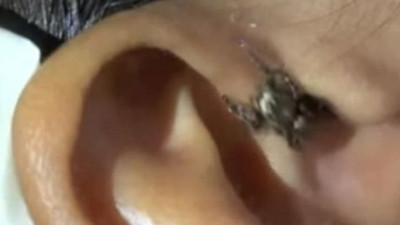 Doktorlar bile şaşırdı! Bu insanların içinden böcekler fışkırdı