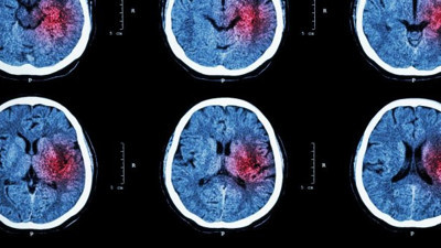 Milyonlarca insan tehdit altında! Beyin kanaması riskini artırıyor