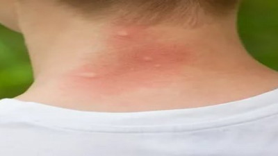 Sivrisinek ısırdığında vücudunuza ne olur?