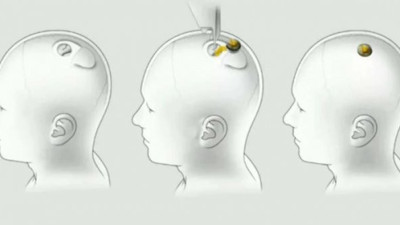 Elon Musk'ın dünyayı değiştirecek projesi Neuralink ,Türk halkına soruldu! Beyninize Neuralink çipi taktırır mısınız?