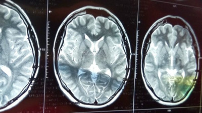 Koronanın uzun süreli bir etkisi daha ortaya çıktı. Yakalananlar kolay kolay atlatamıyor