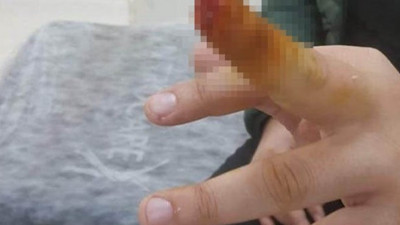 Samsun'da akılalmaz olay. Güvenliğin parmağını ısırarak kopardı